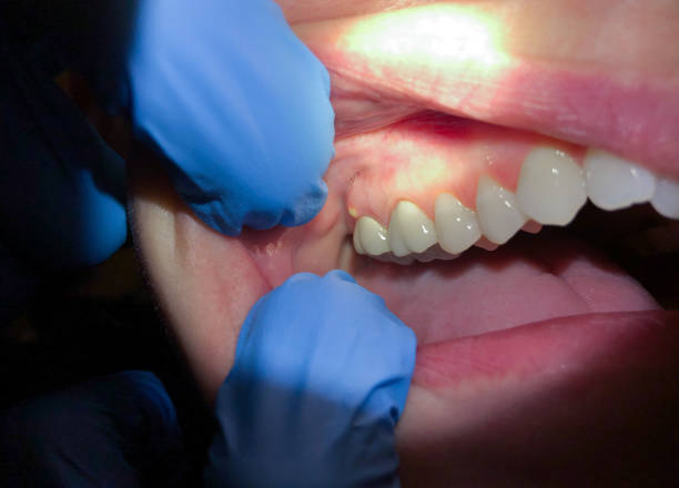 Best Emergency Tooth Extraction in Bemiss, GA